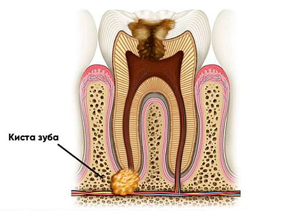 что такое киста зуба